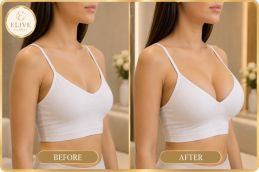 result of scarless breast augmentation Dubai UAE