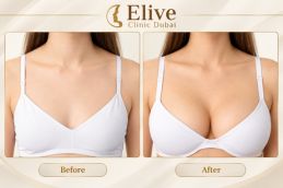 before & After Breast Enlargement Injections in Dubai