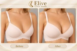 before & After Breast Enlargement Injections in Dubai & Abu Dhabi