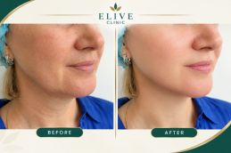 before after Juvederm Fillers in Dubai & Abu Dhabi