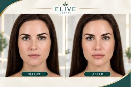before after Juvederm Fillers in Dubai