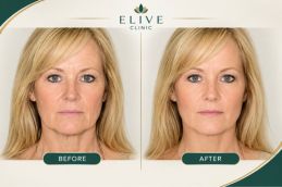 before after Juvederm Treatment in Dubai & Abu Dhabi (1)