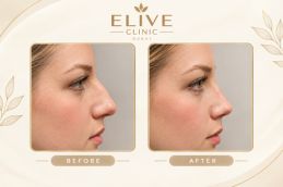 before and after liquid rhinoplasty in dubai & Abu Dhabi