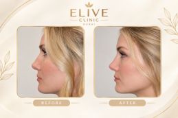 before and after liquid rhinoplasty