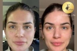 before and after of Volift Fillers in Dubai (1)