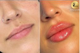 before and after of Volift Fillers in Dubai & Abu Dhabi