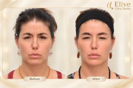 before and after result of Allergan Botox in Dubai & Abu Dhabi