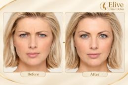before and after result of Allergan Botox in Dubai