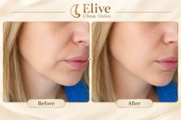 before and after results of Allergan Botox in Dubai & Abu Dhabi